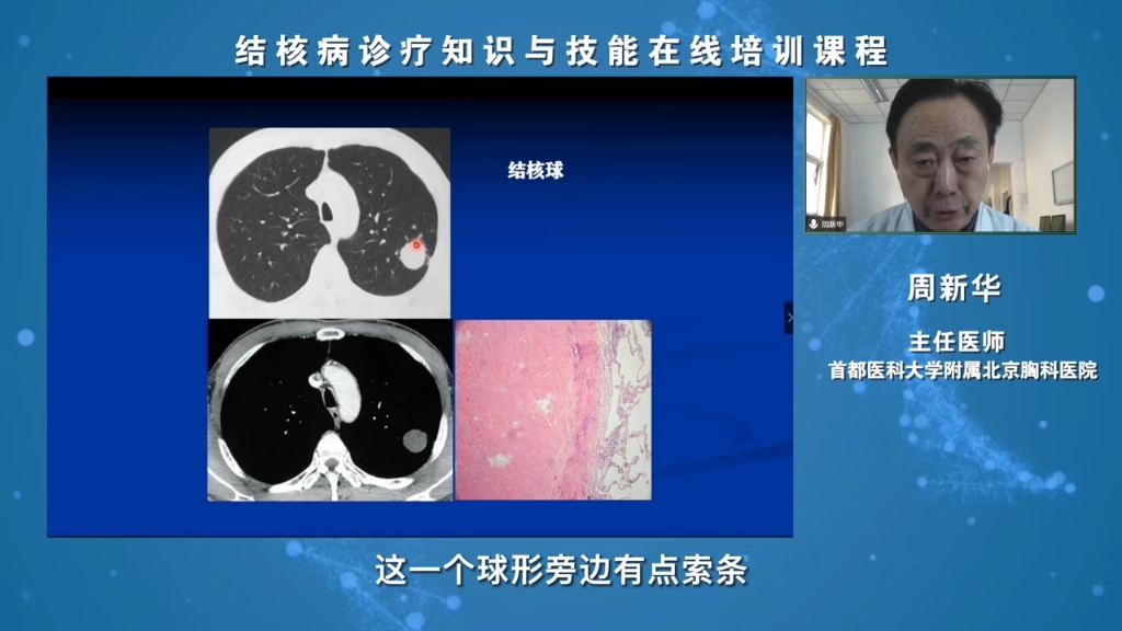 [图]肺结核典型影像学特征