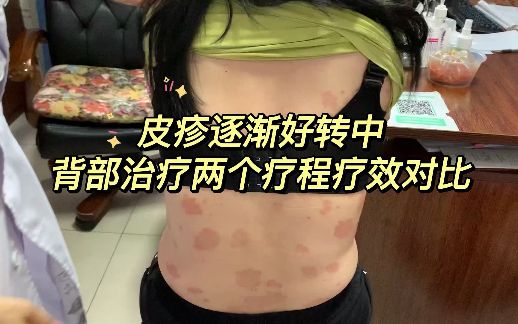 银屑病患者背部疗效对比