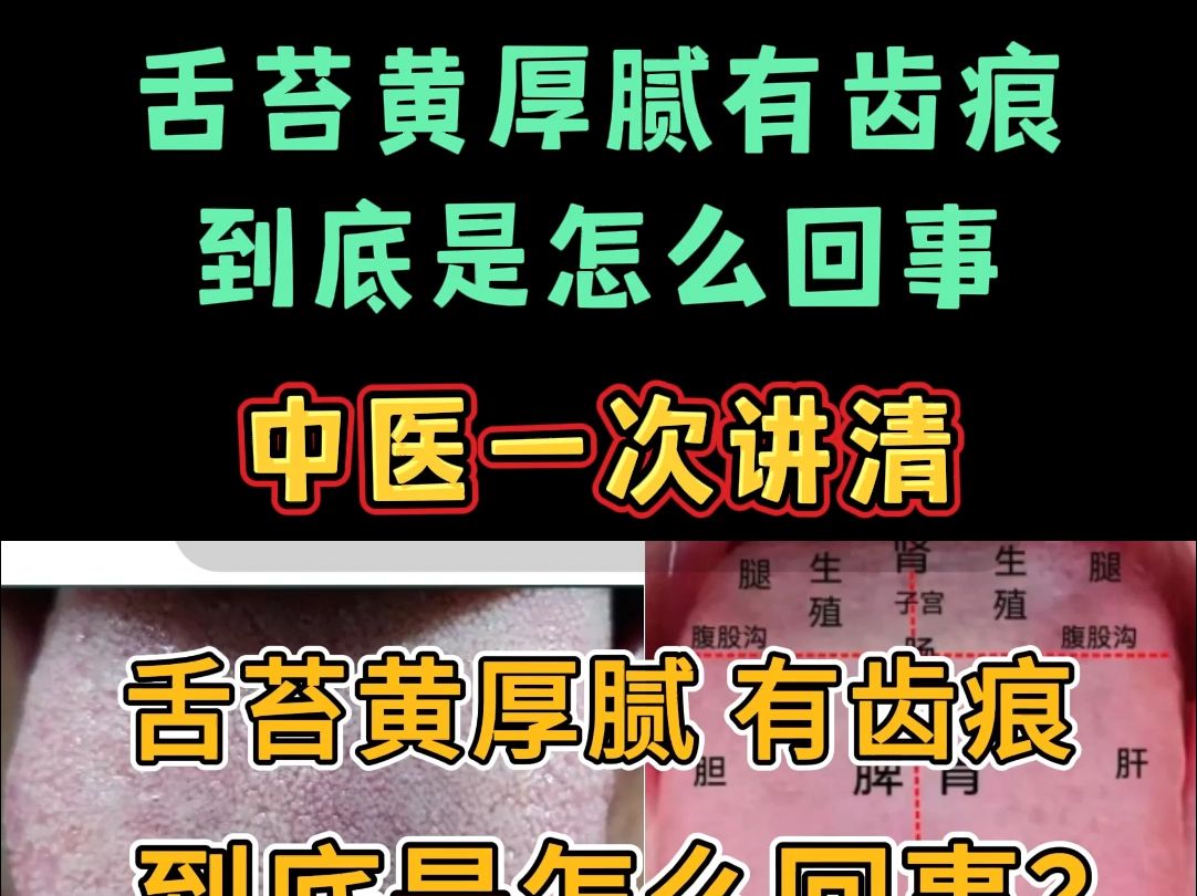 舌苔黄厚腻有齿痕,到底是怎么回事?中医一次讲清!哔哩哔哩bilibili