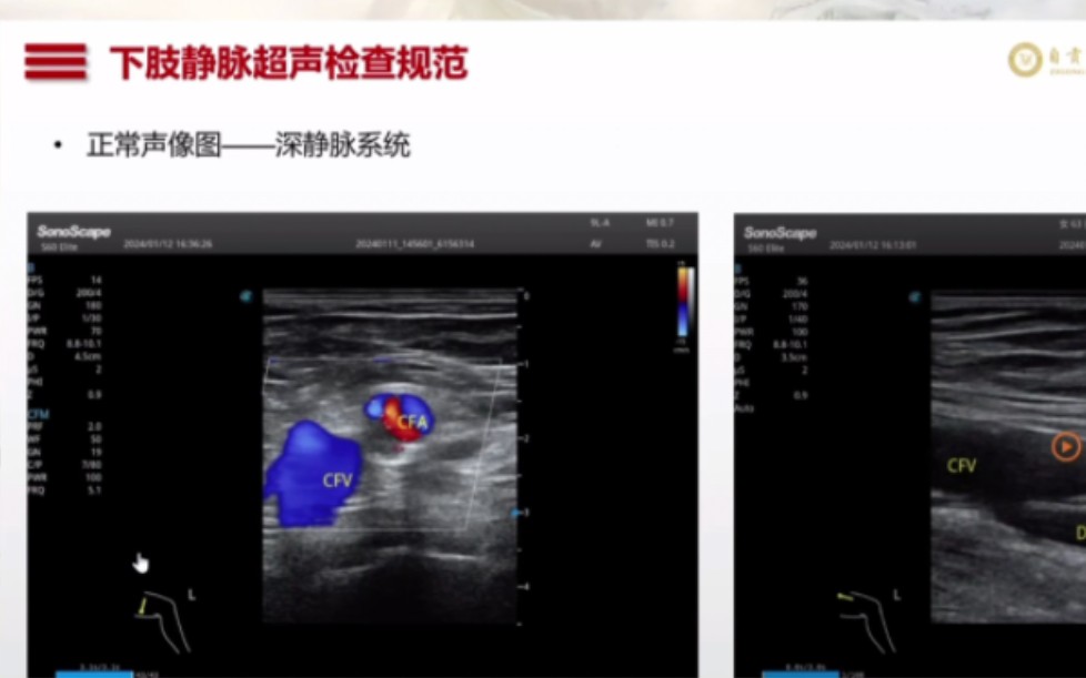 [图]超声:下肢静脉超声规范化检查及常见疾病