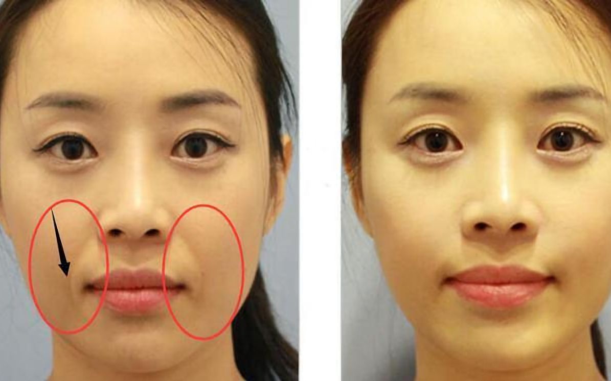 法令纹深显老20岁,教你2个小妙招,改善法令纹,家庭主妇都需要