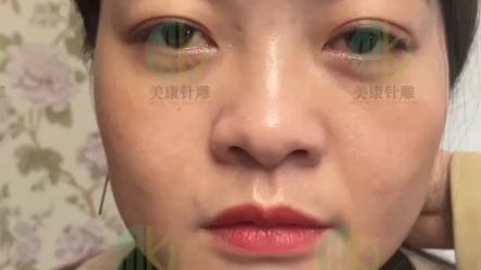 美康针灸美雕作品