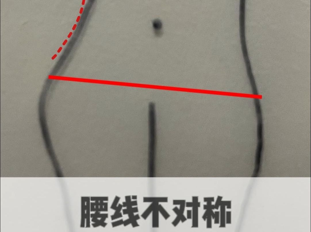 腰线不对称的几种成因