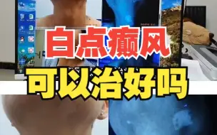 Descargar video: 兰州老中医哪个医院看白癜风好-白癜风已经不再是皮肤顽疾，专业规范的治疗，一定能帮助到你