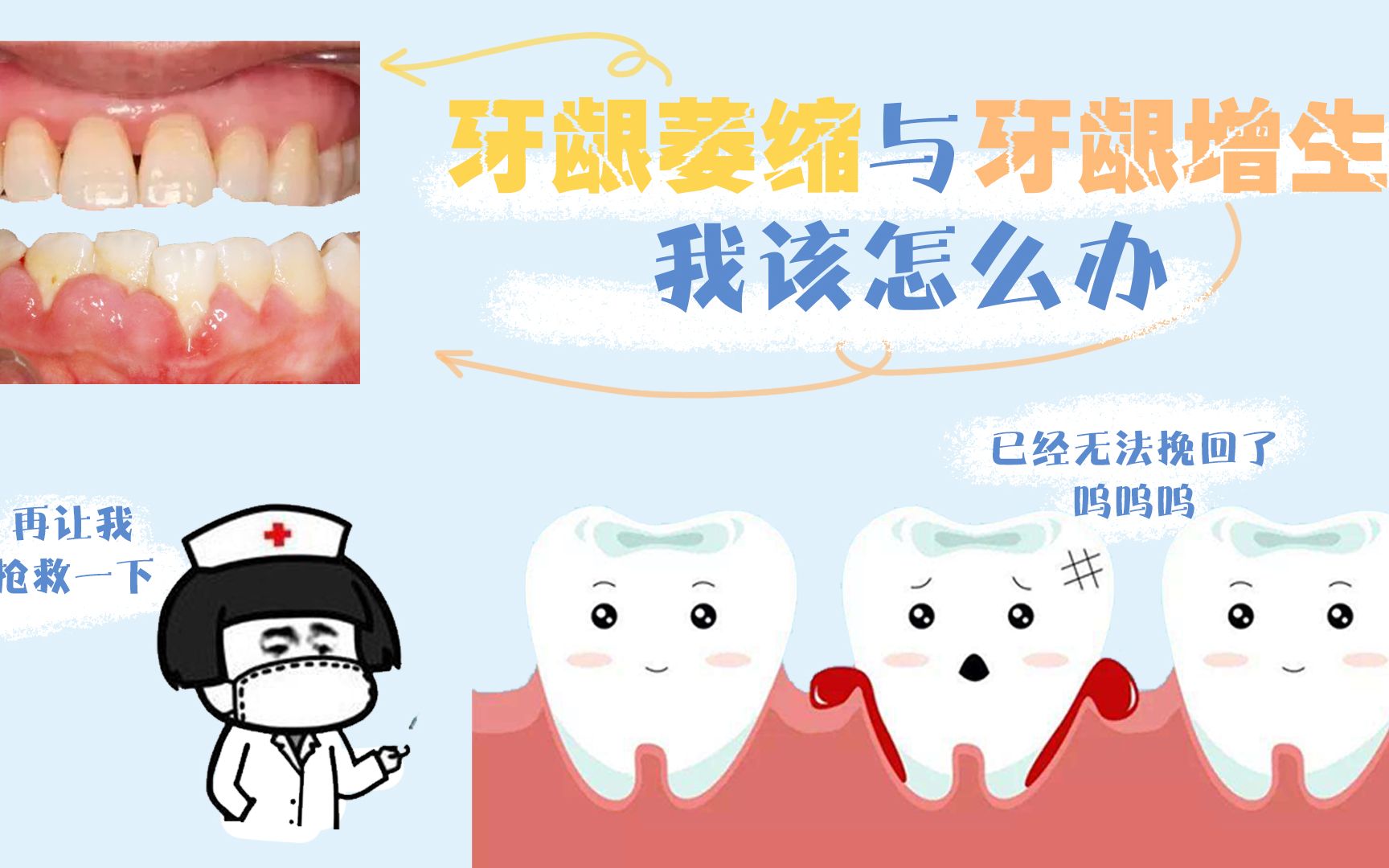 【杨林医生科普:牙龈增生与牙龈萎缩的预防与治疗】有些伤害是不可逆的,早治早好!哔哩哔哩bilibili