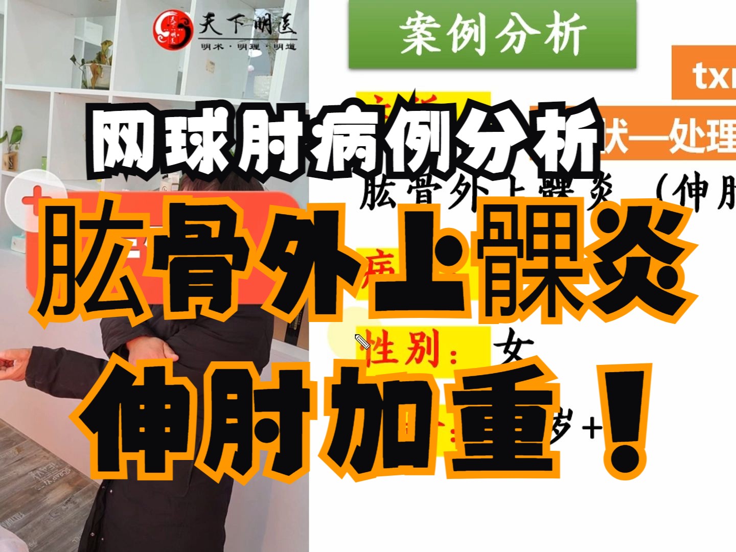 网球肘【病例分析】(肱骨外上髁炎,伸肘加重)——使用天下明医平台简
