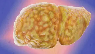 一位男性用夜用感冒药炖鸡，他的肝脏是这么让大脑衰竭的