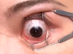 开睑器，给眼珠子滴眼药水