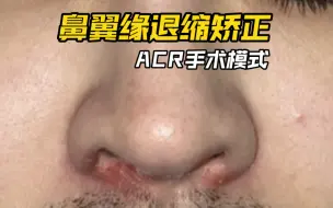 Video herunterladen: 鼻翼缘退缩矫正，ACR手术模式来改善露鼻孔优化海鸥线，来看看吧