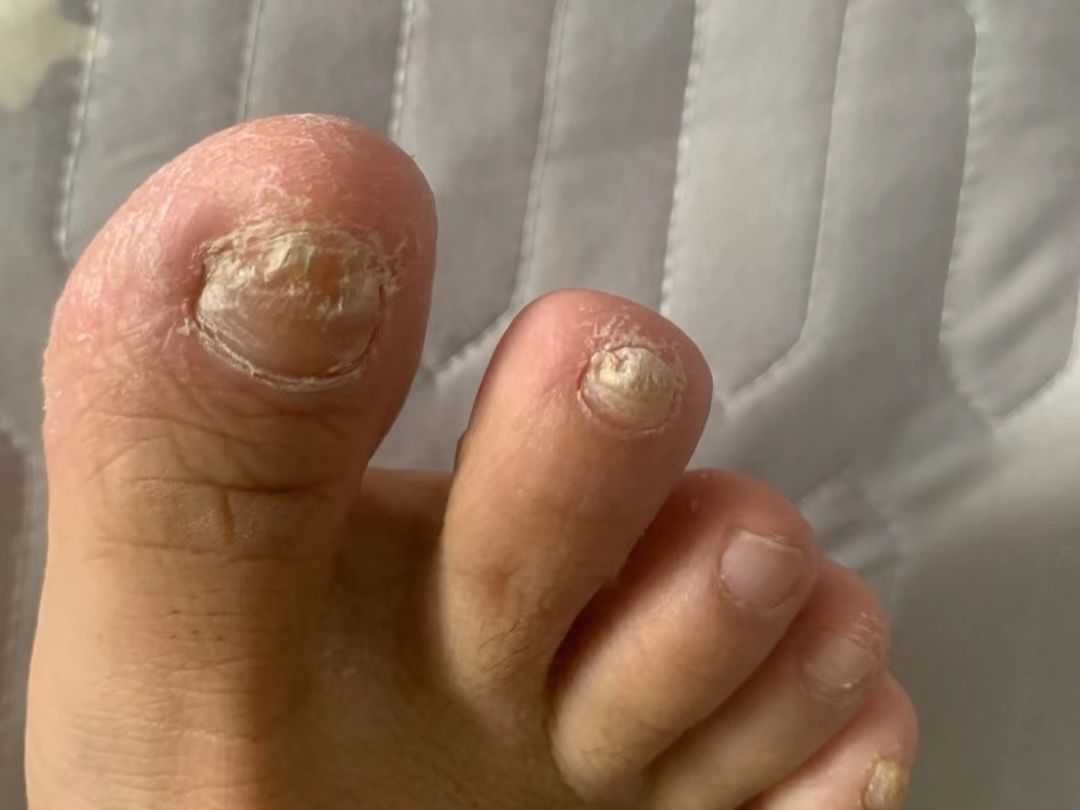 泛黄增厚指甲自己能掉?每天成本不到1块的祛灰妙招!建议收藏!