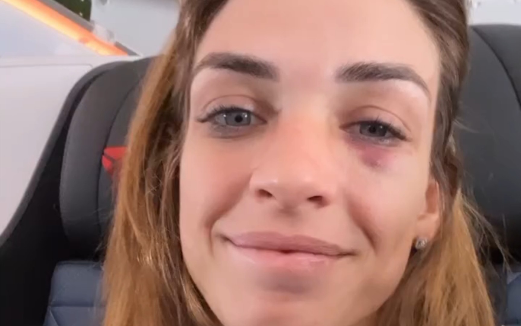 ufc"柔术女神"麦肯齐·邓恩现在的脸