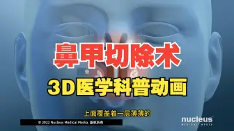 小心空鼻症！鼻甲切除术3D动画还原 （nucleus医学科普视频系列）中文