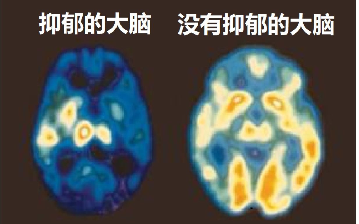 一位大学生受严重的抑郁症的困扰数年,这是他在此期间所经历的事.哔哩哔哩bilibili