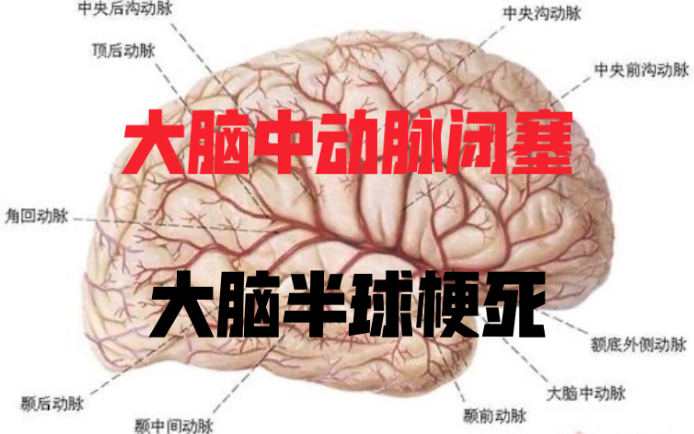 [脑血管疾病6】大脑中动脉闭塞型脑梗死哔哩哔哩bilibili