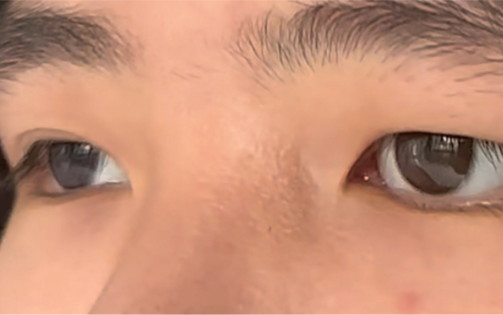 星眸义眼 - 不同角度看义眼佩戴效果