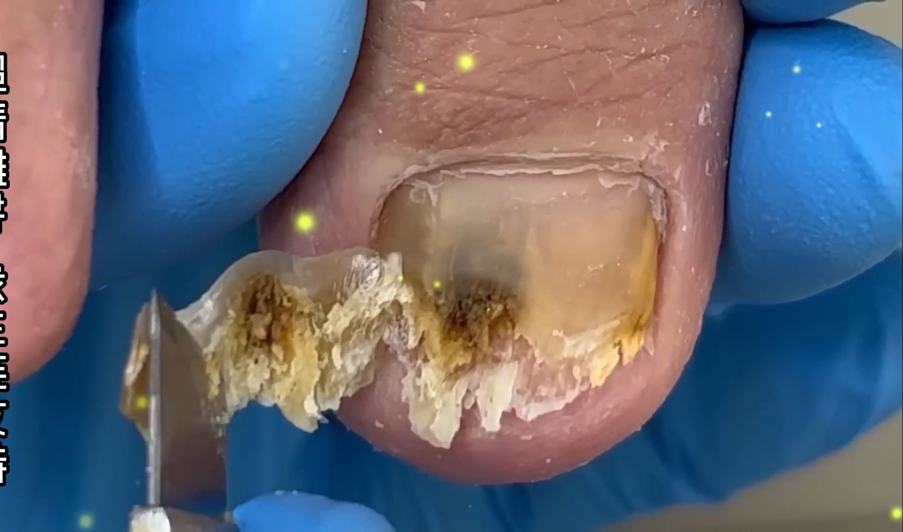 灰指甲伴随甲沟炎,解压视频