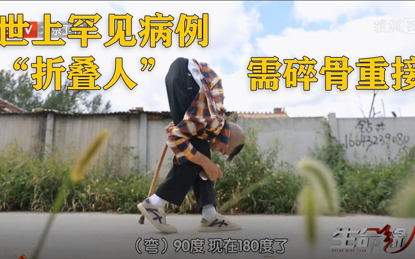 强直性脊柱炎病例"折叠人",医者仁心助其磐涅重生