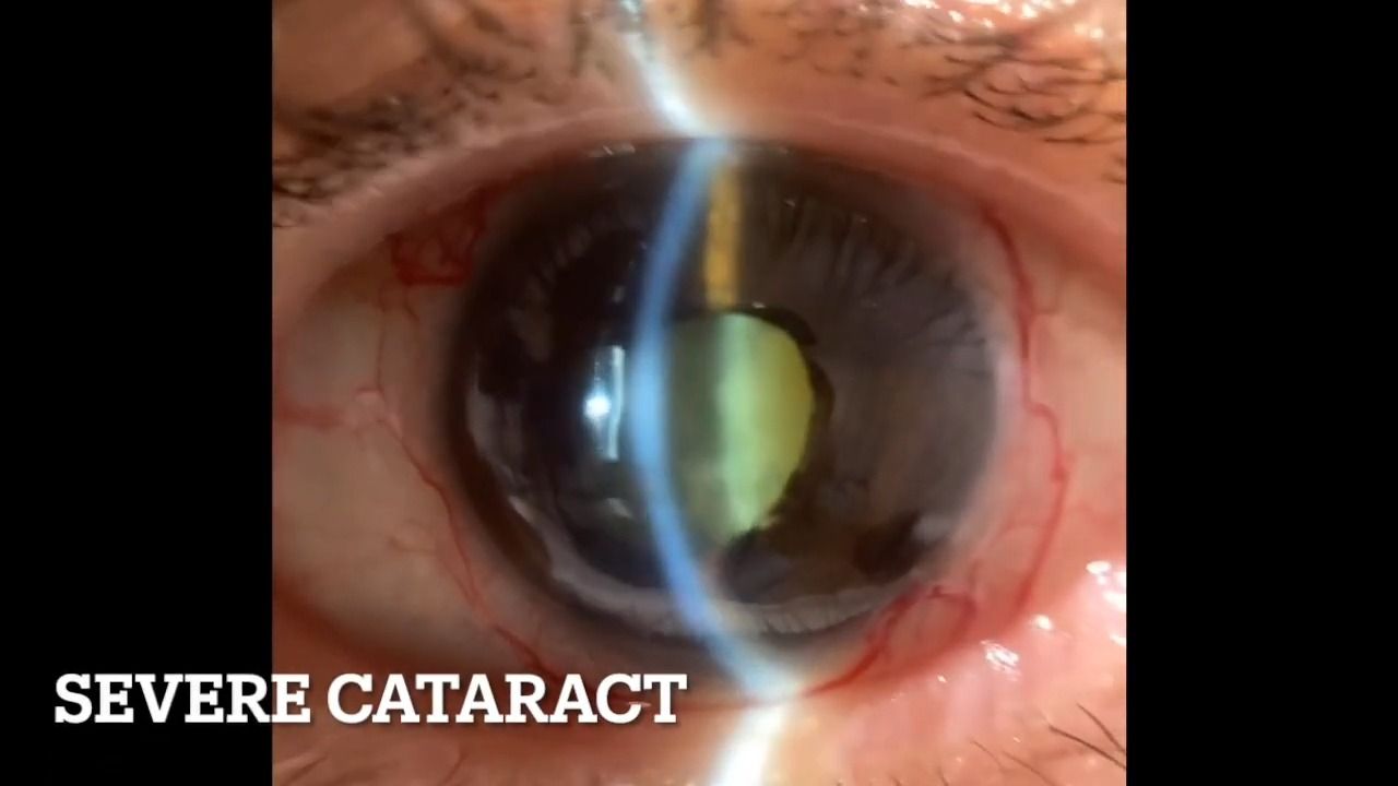 Severe Cataract  严重白内障哔哩哔哩bilibili