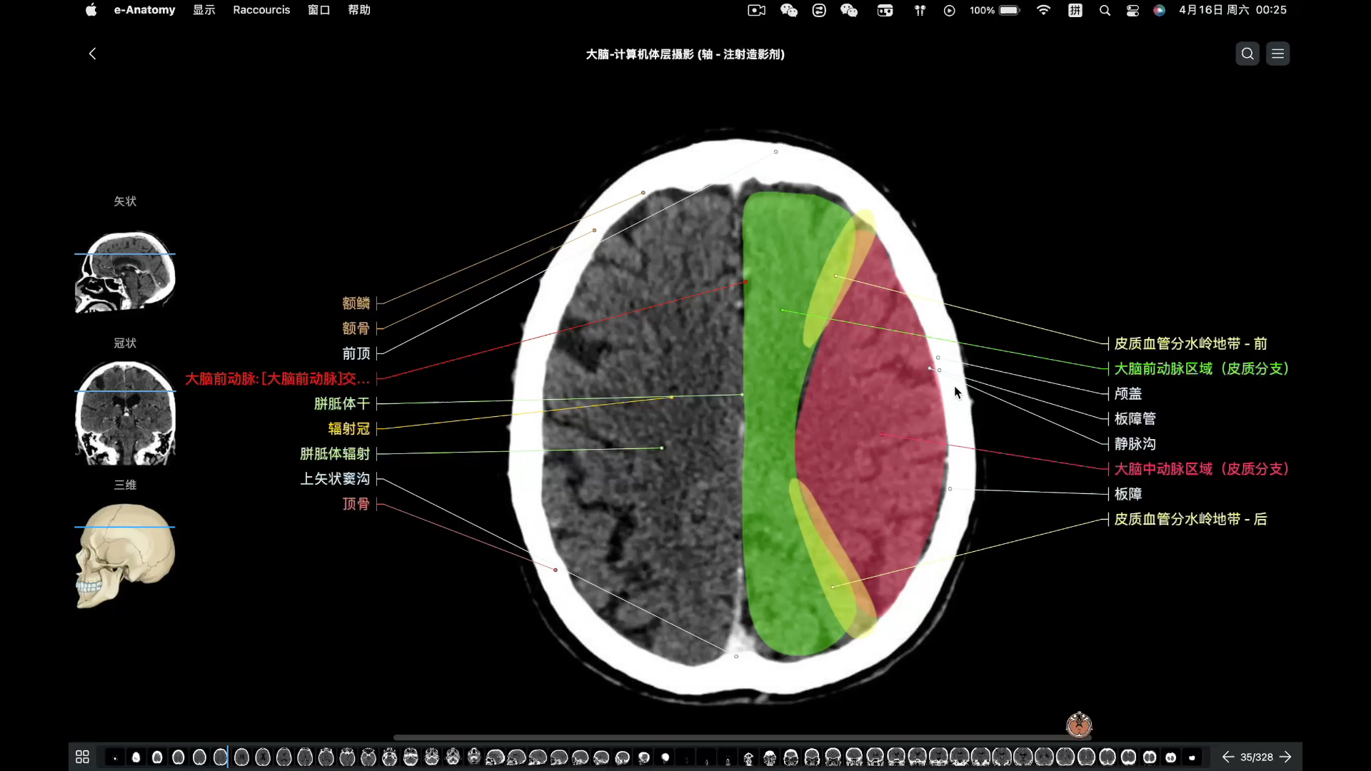 [图]推荐一个好用的中文版断层影像解剖图谱-头颅CT篇（应用名称：e-anatomy）