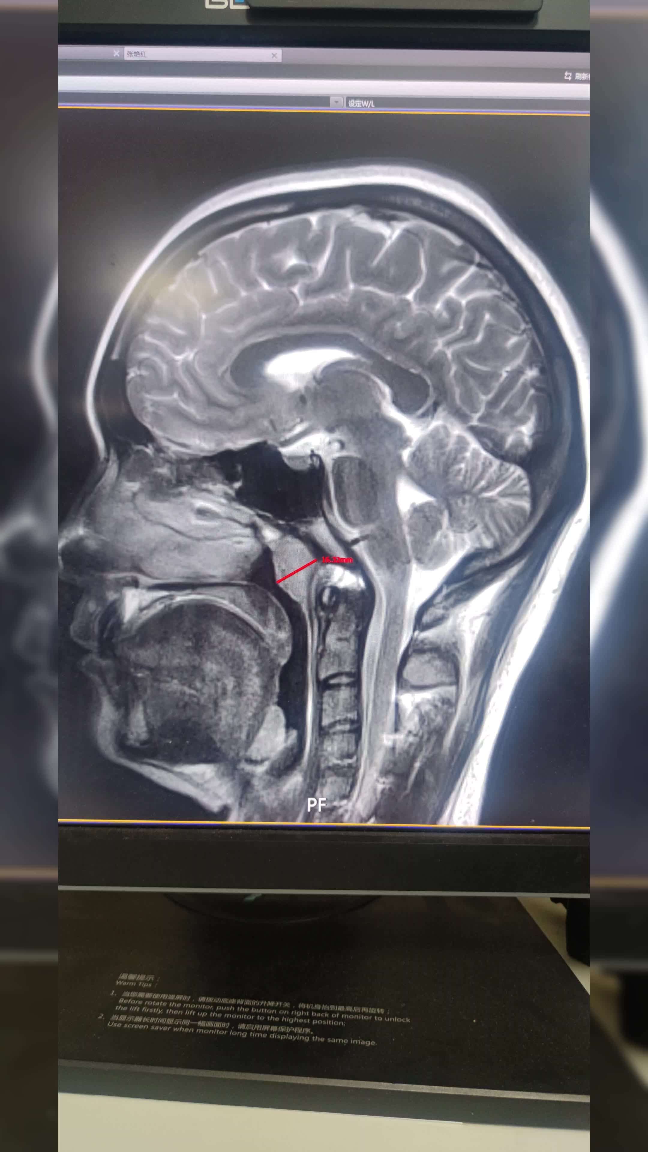 28岁患者仍然存在重度腺样体肥大