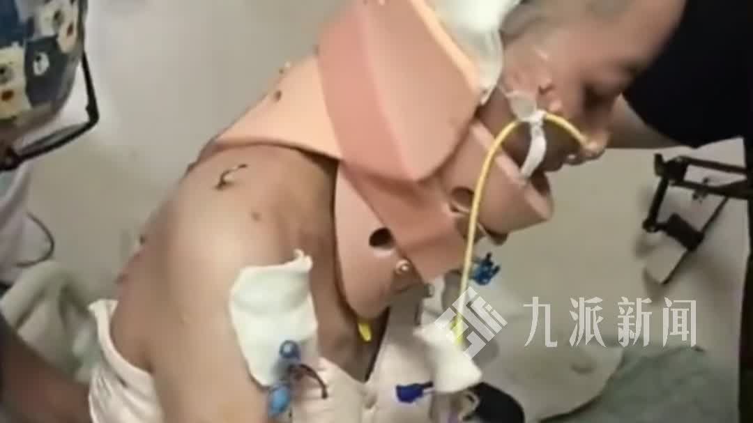 35楼坠落女子奇迹生还，讲述死里逃生：经历14小时手术，右腿截肢，在ICU50天