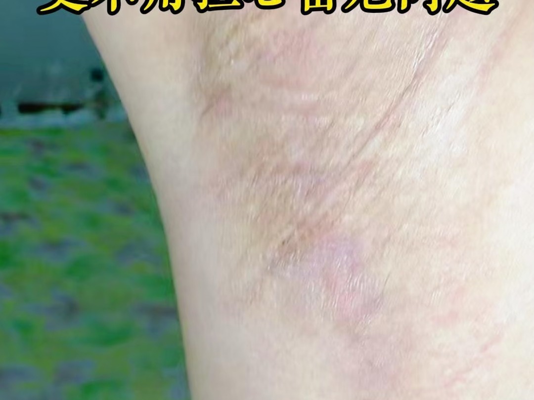 腋臭手术会留疤吗?