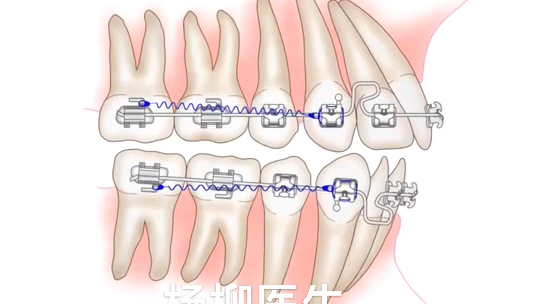 什么是金属自锁牙套,金属自锁牙套矫正牙齿的原理和效果!进口自锁牙套效果和性价比都非常高.也是选择最多的一种牙套!哔哩哔哩bilibili