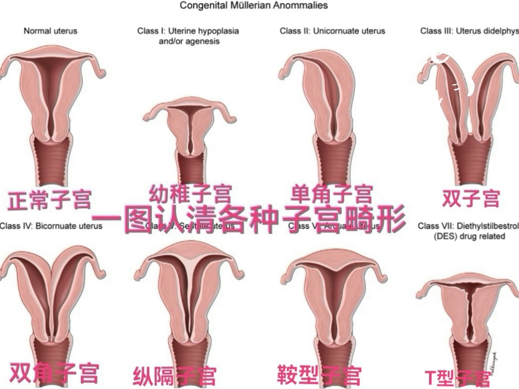 一圖認清各種子宮畸形