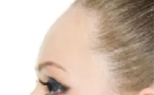 Download Video: your forehead is so round!~forehead contouring procedure