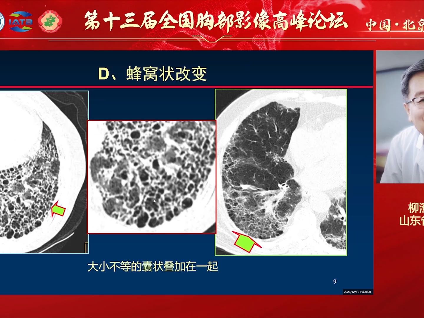 [图]从病理改变看病毒性肺炎的CT征象--柳澄