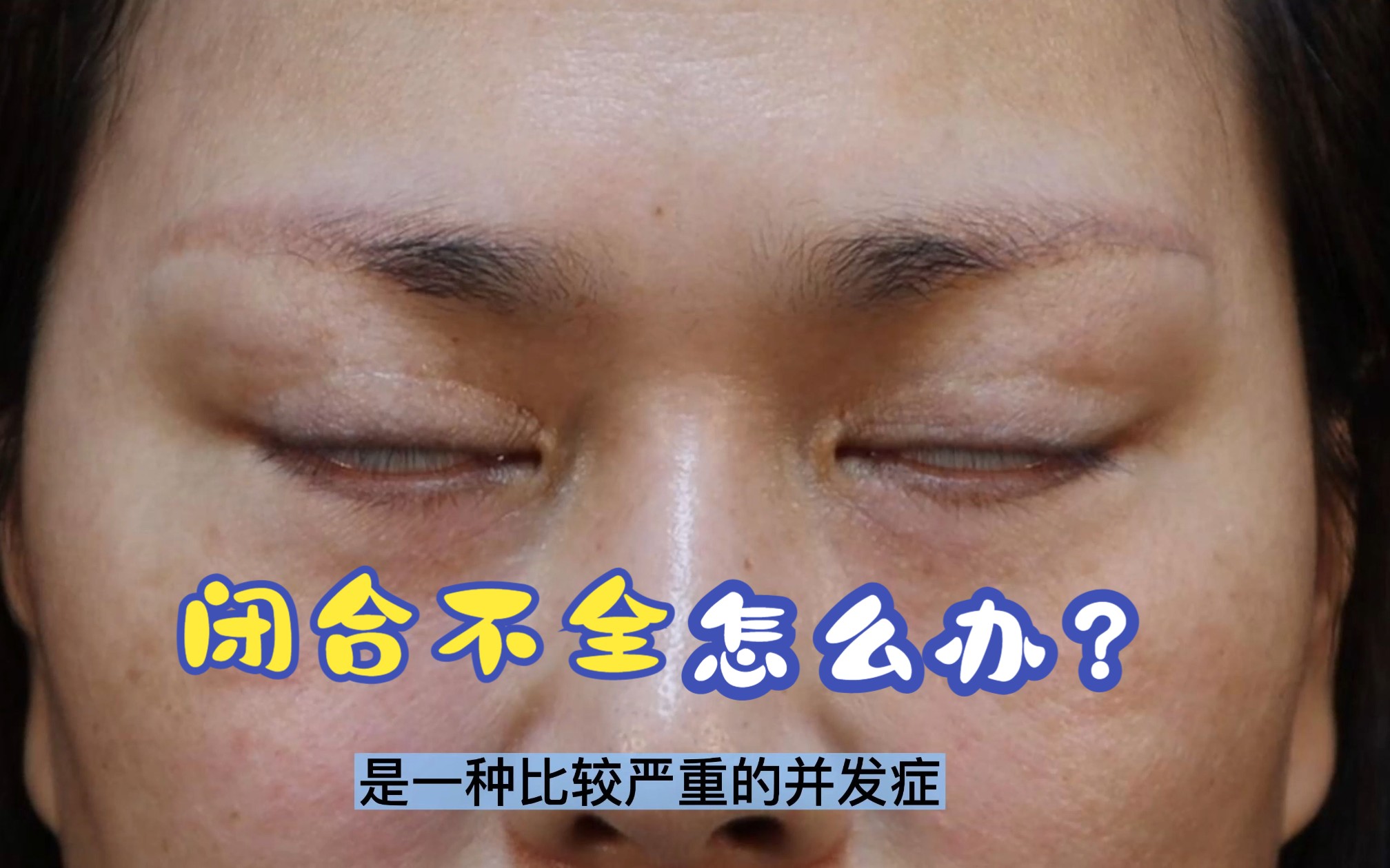 眼袋术后并发症之一眼睑闭合不全怎么办?