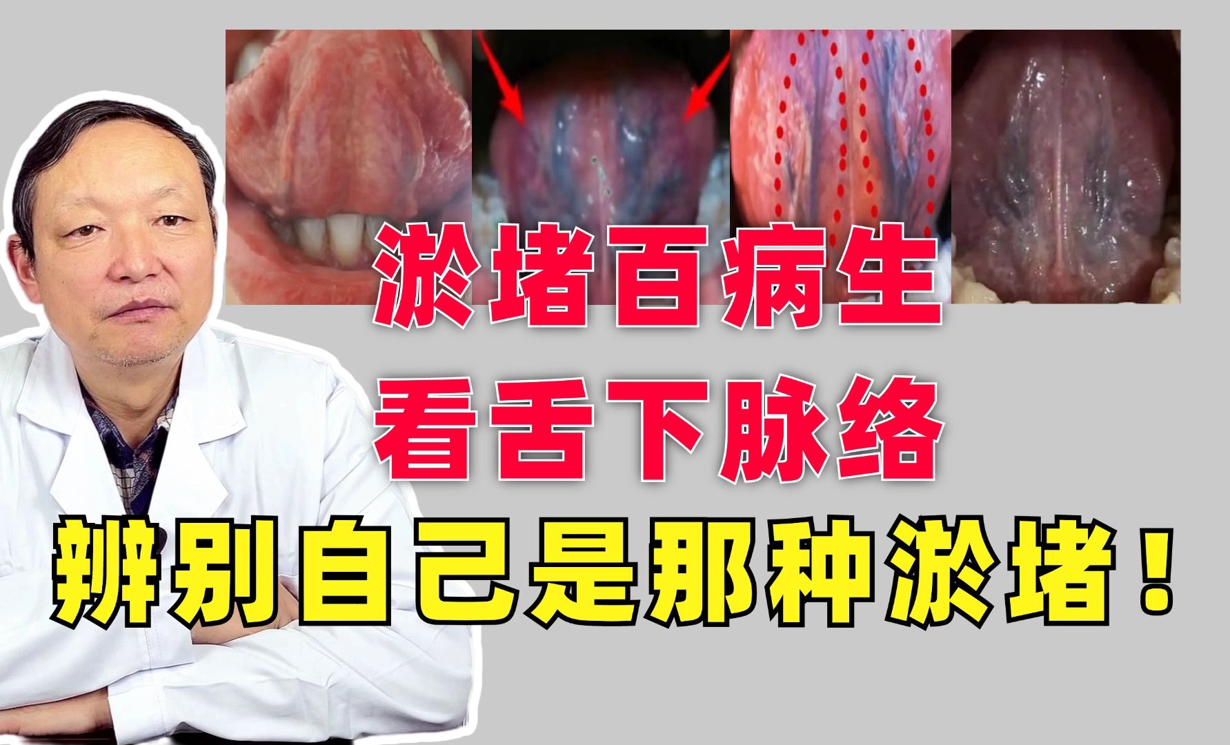 淤堵百病生,看舌下脉络,辨别自己是那种淤堵!