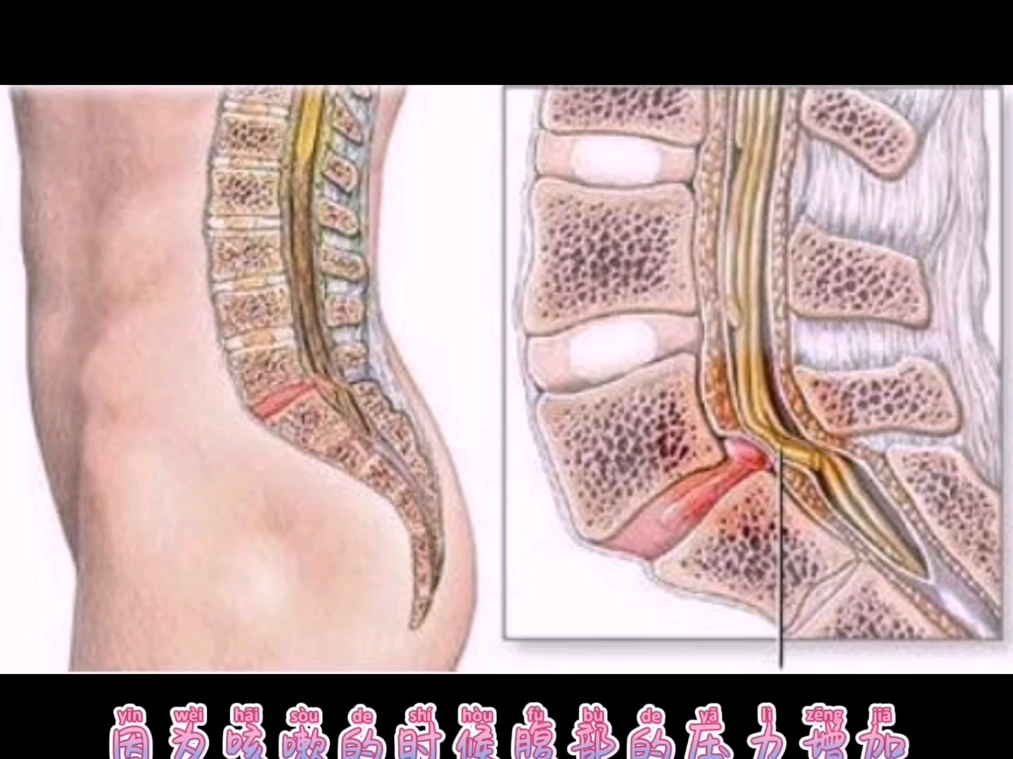 [图]腰椎间盘突出症，自我判断