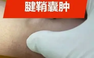 下载视频: 长了7个月的腱鞘囊肿