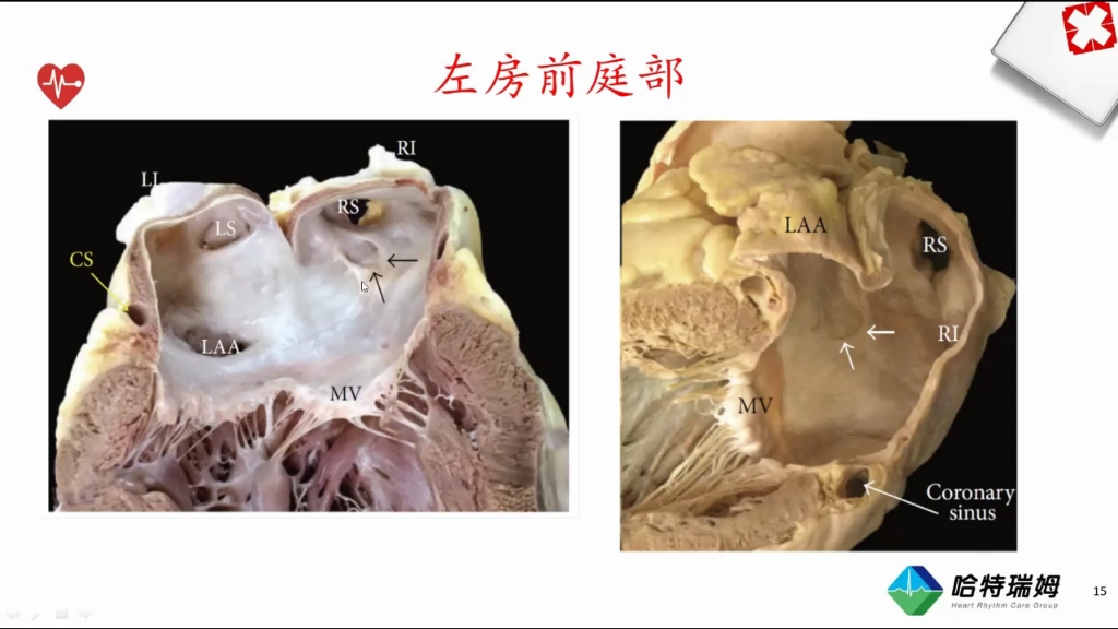 [图]心脏超声解剖:左心房解剖（全套共52集，讲解心脏解剖，超详细，学好心脏超声的基础就是学好心脏解剖）