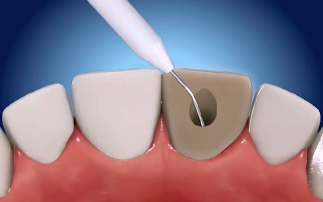 门牙根管治疗