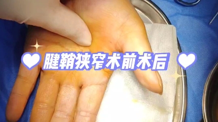 狹窄性腱鞘炎術前術後對比效果