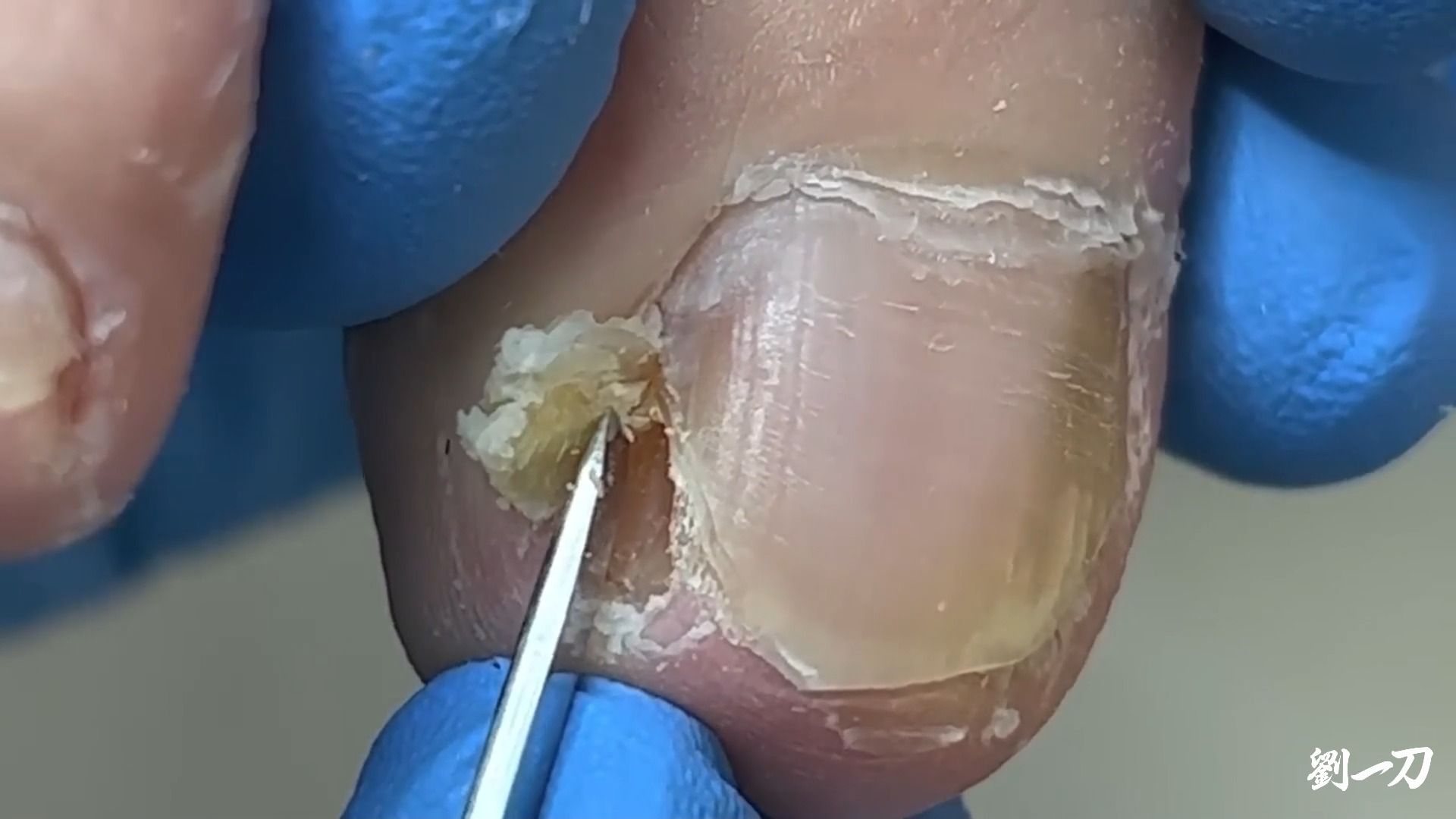 【劉一刀修脚】【甲沟炎】挖在指甲肉里的死皮.