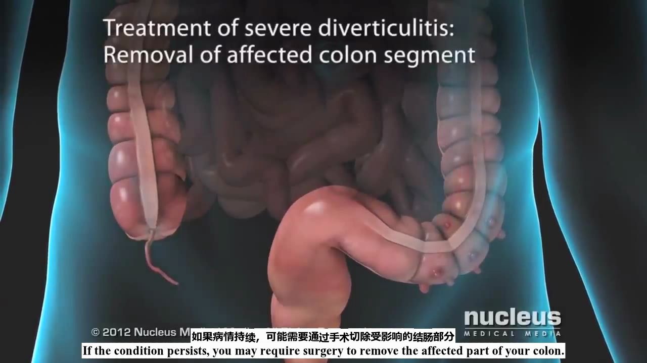 【Nucleus Medical Media 双语】憩室病哔哩哔哩bilibili