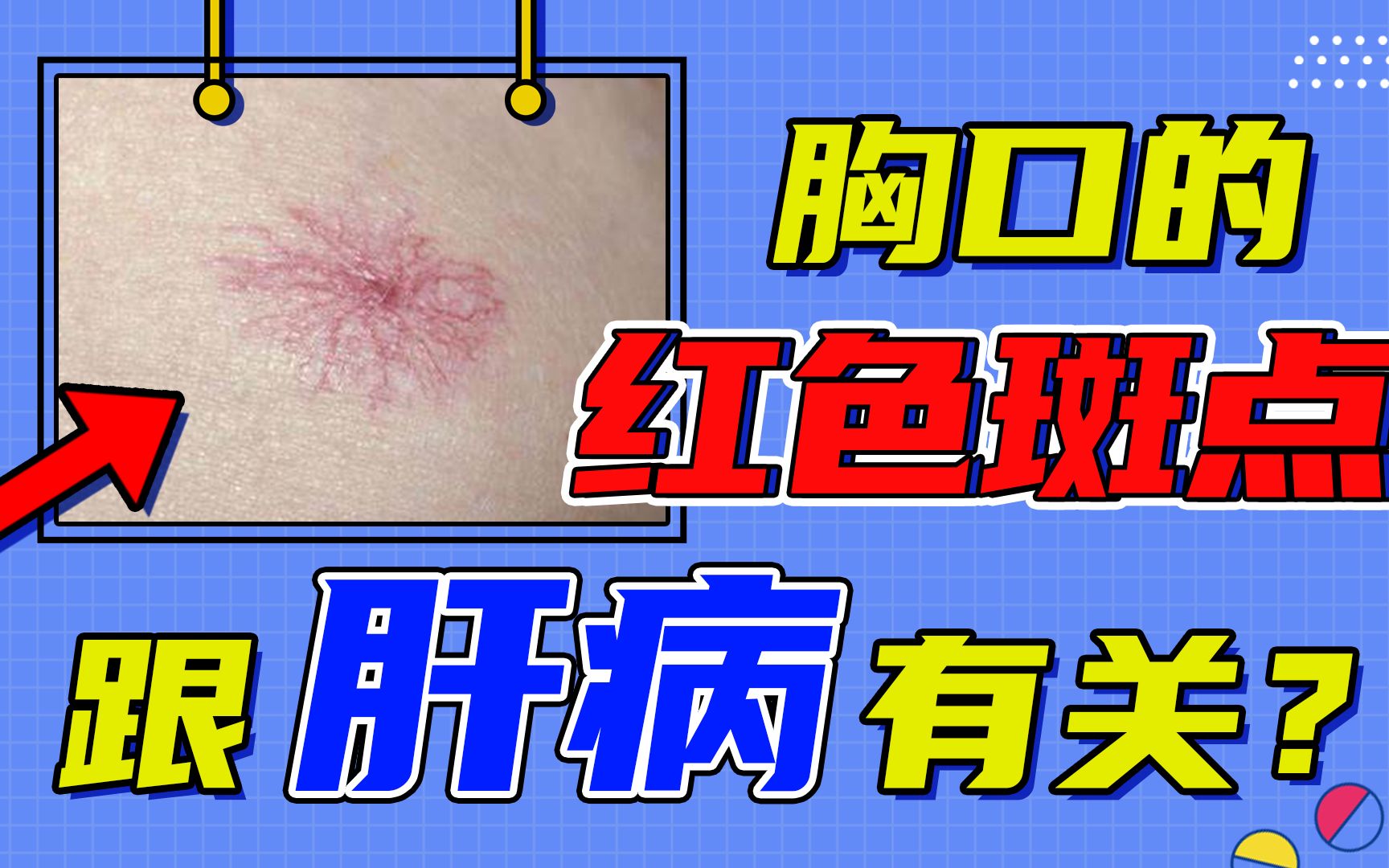 胸口突然出现红色斑点,棉签一压像个"蜘蛛",可能肝脏出了问题!