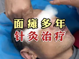 Descargar video: 面瘫，中医使用针灸治疗