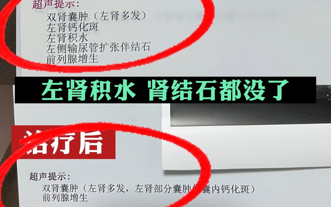 肾结石,肾积水21副中药全好了