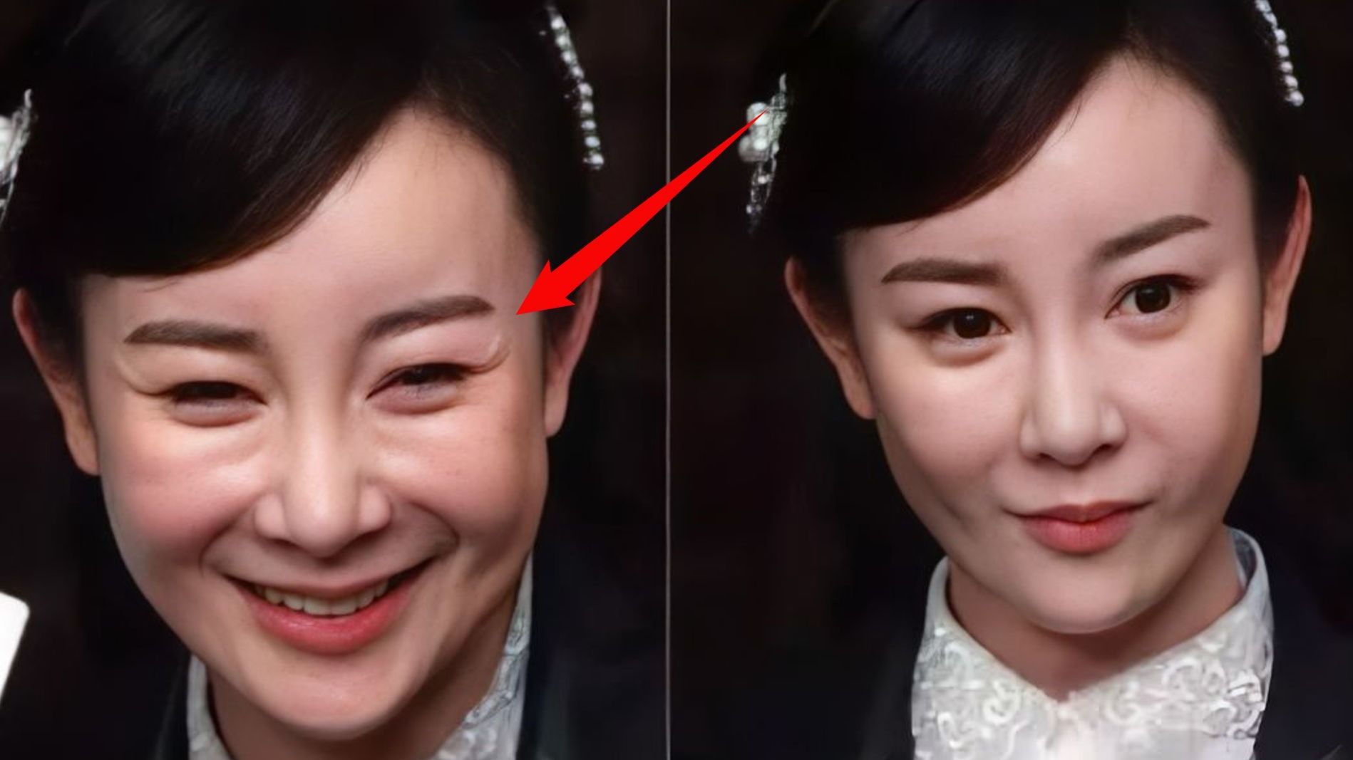 张檬颜值回春,取出鼻子假体后,面部肿胀消失,曾自曝后悔整容