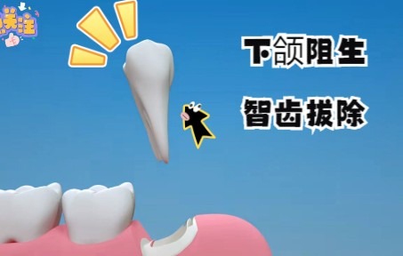 下颌阻生智齿拔除,3D动画演示,超声骨刀拔智齿!哔哩哔哩bilibili