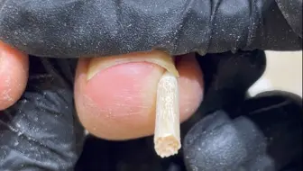 做了两次美甲甲沟炎就上岸了