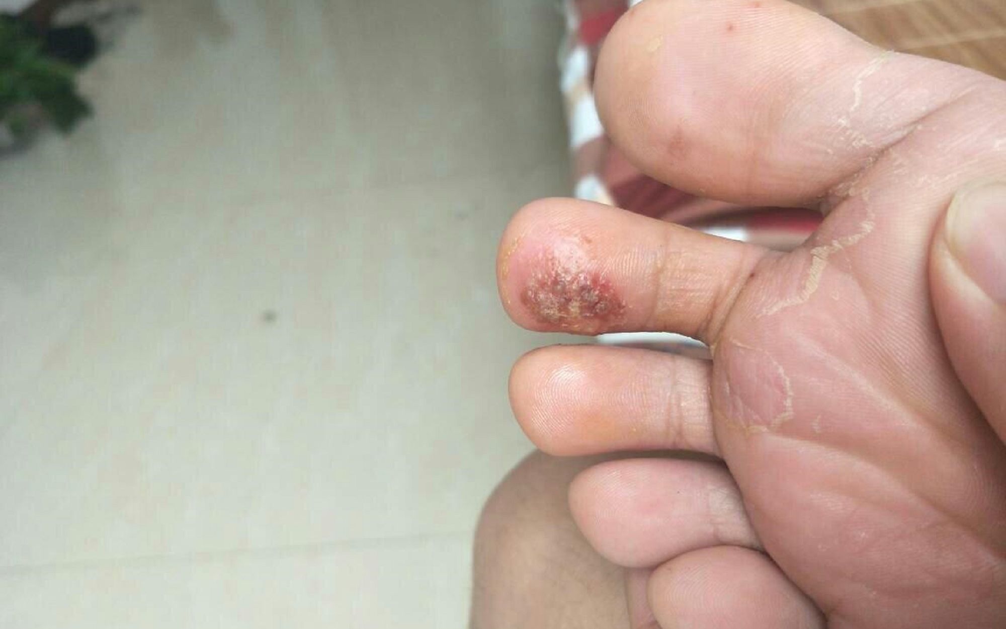 低成本治愈脚气!方法简单不费时间,学会马上远离水泡脚趾糜烂!