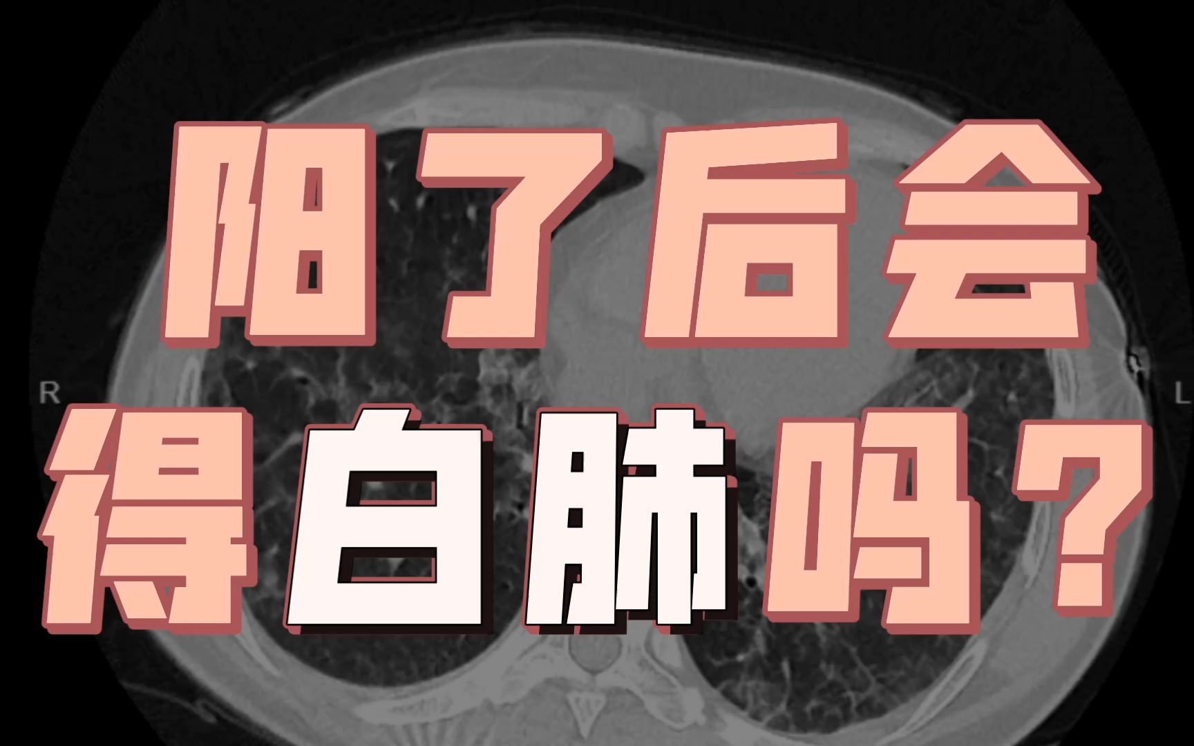 阳了会得白肺?奥密克戎其实不攻击肺?为什么会出现怎么治疗?哔哩哔哩bilibili