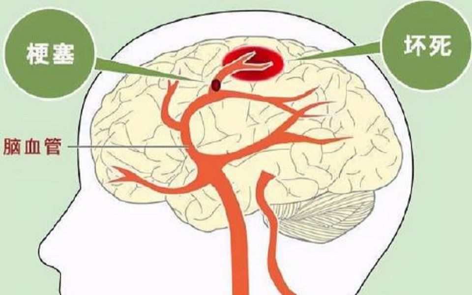 脑卒中动画片 六脑卒中的二级预防 超清(720p).