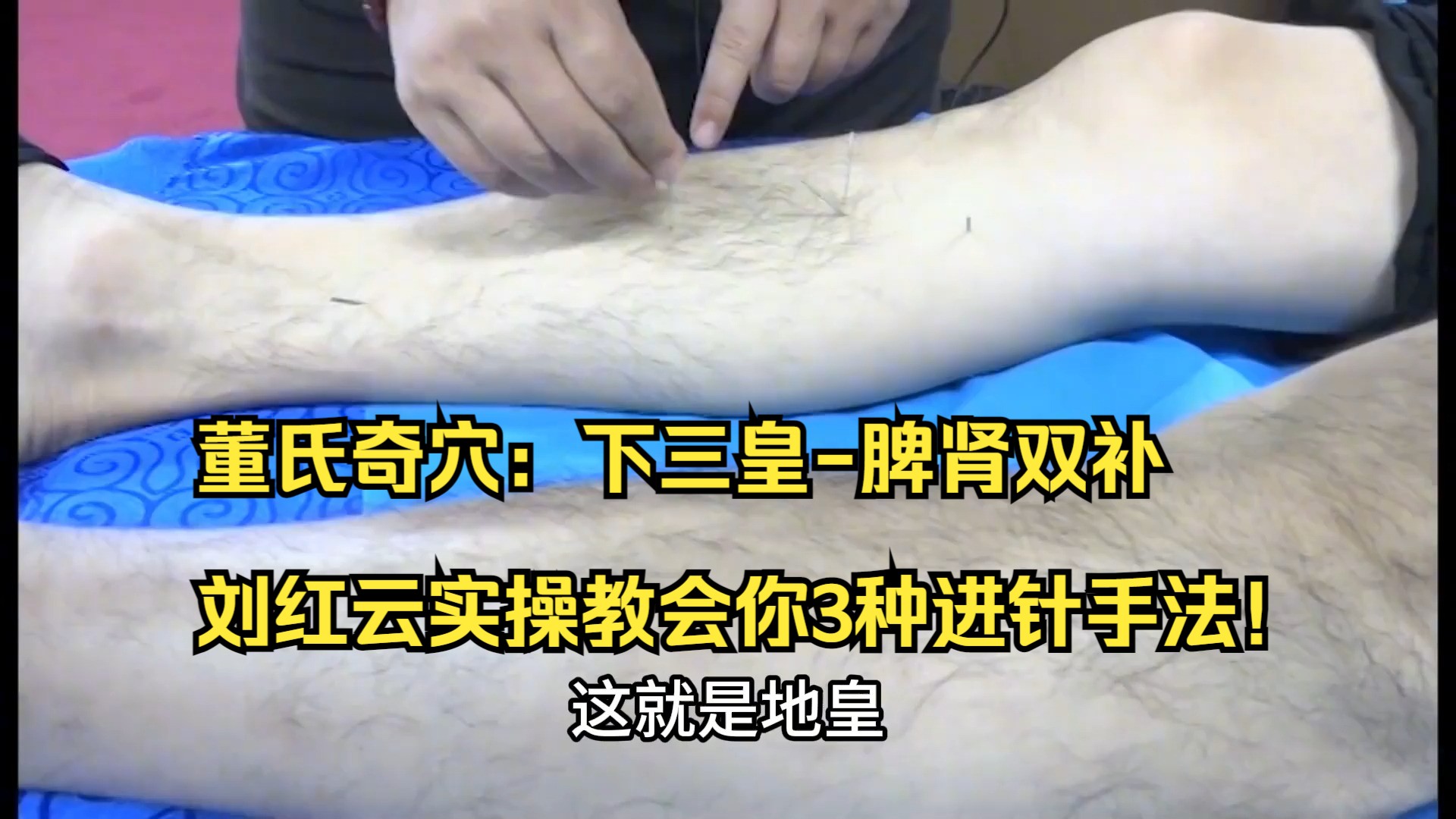 董氏奇穴:下三皇-脾肾双补,刘红云实操教会你3种进针手法!