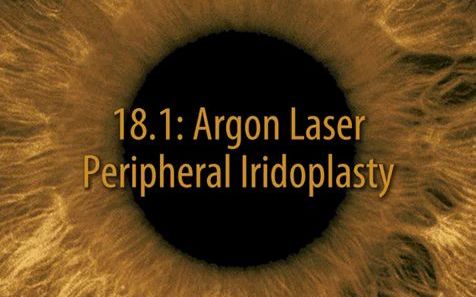 [图]【氩激光虹膜周围成形术一例】Argon laser peripheral iridoplasty